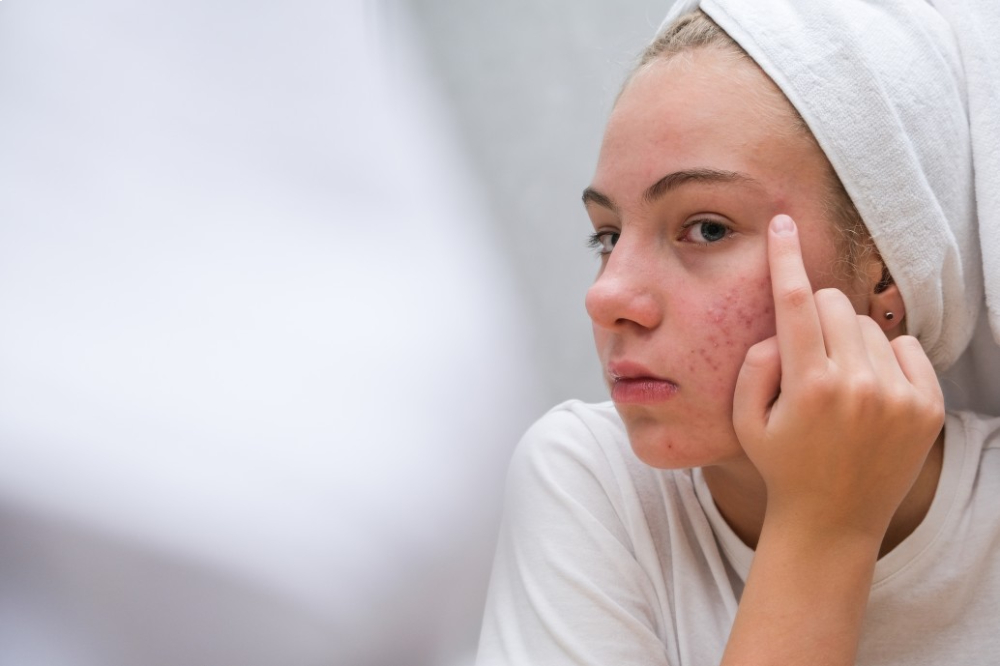 Comment prévenir l’acné avant les régles