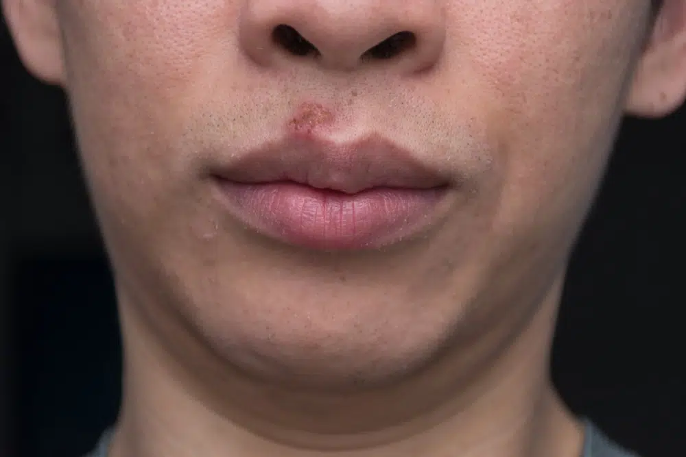 Comment soulager les démangeaisons de la bouche Comment soulager les démangeaisons de la bouche