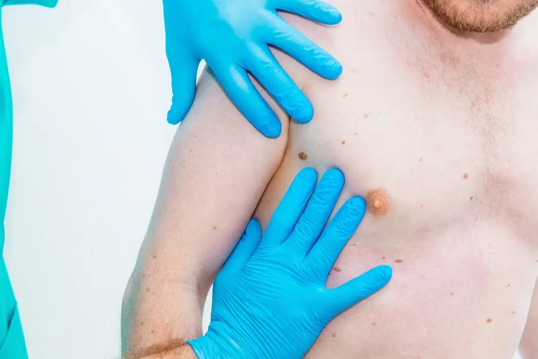 Comment prévenir le cancer de la peau Comment prévenir le cancer de la peau